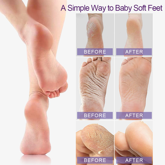  Baby Foot Peel Mask-Original Exfoliant Foot Peel-Callus Remover  for Rough Cracked Dry Feet-Dead Skin Remove-Foot Peeling Mask for Baby Soft  Feet - Lavender Scented : Beauty & Personal Care